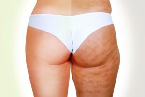 Normale VS Cellulite